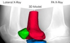 RSIP Vision宣布突破性AI技术可通过X射线图像对膝盖进行3D重建